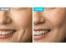 CHARDE Cloud Ampoule Kit