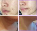 ENVOL pretti Neckliju Cold Plasma Beauty Device