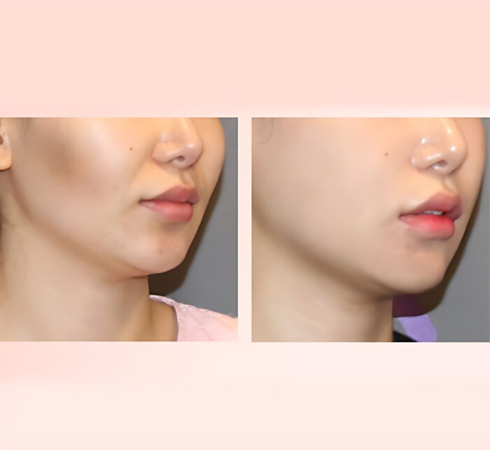 DERMA BUILD Bortide Balloon Ampoule 10ml - Image 2