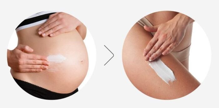 ATOPALM Stretch Mark Cream 150ml - EmpressKorea