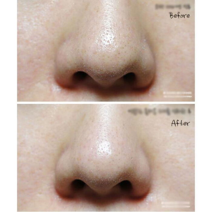 Ciracle Blackhead Off Cotton Mask 20EA*5ml - EmpressKorea